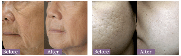 LifeScape Aesthetics New eTwo Device